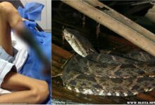 Voce nao acredita o que uma picada de cobra pode fazer imagens fortes 1