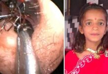 Mais de 1000 formigas foram retiradas do ouvido de uma crianca indiana