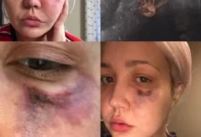 Mulher acorda com uma dor insuportavel furo no rosto e uma aranha na mao