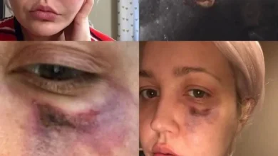 Mulher acorda com uma dor insuportavel furo no rosto e uma aranha na mao