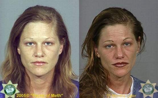 Faces-of-Meth-Before-and-After-Death_44