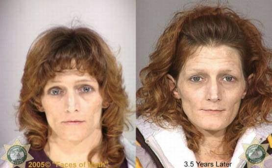 Faces-of-Meth-Before-and-After-Death_49