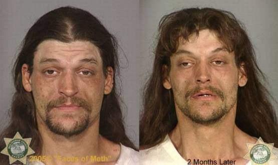 Faces-of-Meth-Before-and-After-Death_51