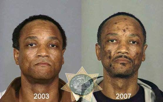 Faces-of-Meth-Before-and-After-Death_9