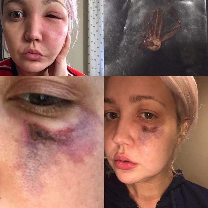 Mulher acorda com uma dor insuportável, furo no rosto e uma aranha na mão