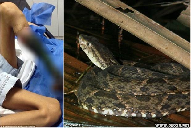 Você não acredita o que uma picada de cobra pode fazer (imagens fortes) 13 Você não acredita o que uma picada de cobra pode fazer (imagens fortes)