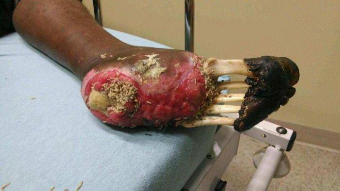 mendigo diabetico nao tirou o sapato por 10 anos inteiros 2