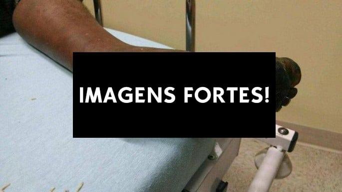 mendigo diabetico nao tirou o sapato por 10 anos inteiros