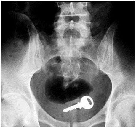 Algumas coisas muito estranhas encontradas no ânus das pessoas 15 noticias doidas cu1