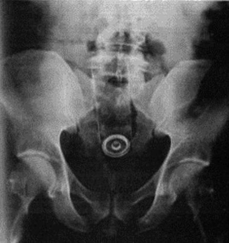 Algumas coisas muito estranhas encontradas no ânus das pessoas 25 noticias doidas cu11