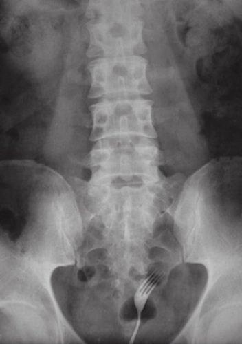 Algumas coisas muito estranhas encontradas no ânus das pessoas 18 noticias doidas cu4