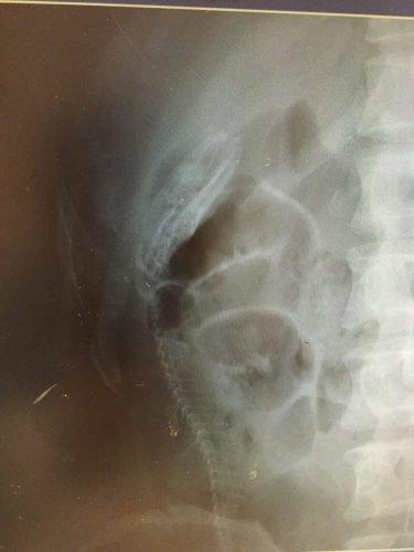 Algumas coisas muito estranhas encontradas no ânus das pessoas 20 noticias doidas cu6