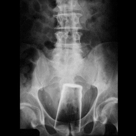 Algumas coisas muito estranhas encontradas no ânus das pessoas 22 noticias doidas cu8