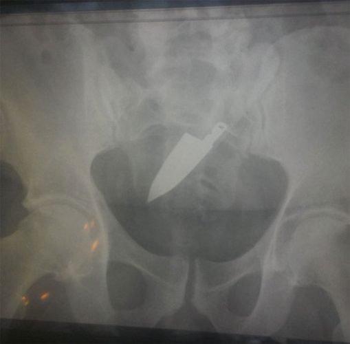 Algumas coisas muito estranhas encontradas no ânus das pessoas 23 noticias doidas cu9